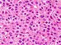 Well-differentiated HCC