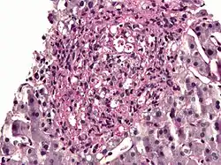 Histoplasma in a granuloma. PAS diastase stain.