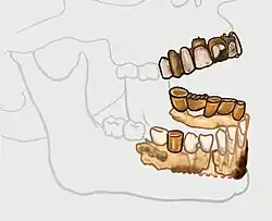 Hitler's mandibular remains were sundered at the alveolar process.