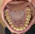 Upper teeth
