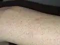 Scar after 6 months