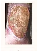 Intractable leg ulcer above the ankle on first visit