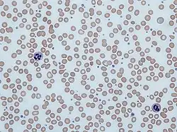 Microsopic view with Giemsa staining of a blood smear with abnormally small and translucent red blood cells