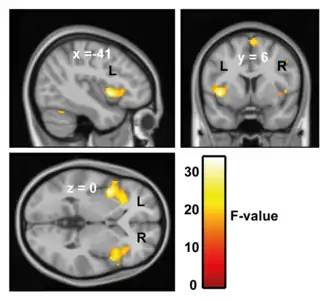 Three greyscale images depicting sections of the brain, onto which orange and yellow highlighting (representing effects) has been projected, along with an accompanying scale. The effect highlighting is concentrated in the anterior insular cortex.