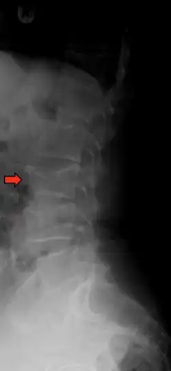 X-ray of the lumbar spine with a compression fracture of the third lumbar vertebra.