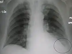 AP CXR showing left lower lobe pneumonia associated with a small left sided pleural effusion
