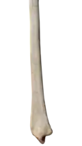 Lateral view of right distal radius