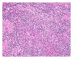 Low power view of IgG4-related prostatitis