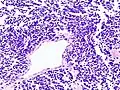 Histopathologic image of small-cell carcinoma of the lung. CT-guided core needle biopsy.