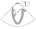 90° two chamber