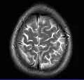 MRI image of the surface of the brain.