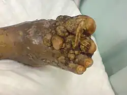 Image 43Eumycetoma (from Fungal infection)