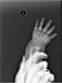 X-ray image of human infant left hand.