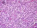 Gleason score 8 (4+4) with fused glands with cytoplasmic vacuoles