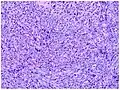 Micrograph of tumor stage. Well-circumscribed spindle-cell tumor. Erythrocytes lie within poorly defined slit-like vascular spaces.[16]