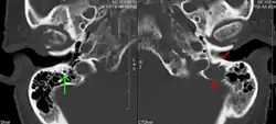 A CT of the brain revealed a lytic lesion in the left temporal bone (red arrow), and petrous temporal bones involving the mastoid segment of the facial nerve canal (green arrow).