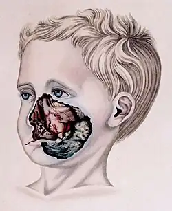 Drawing of boy with gangrene around mouth, nose, cheek