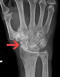 Severe osteoarthritis and osteopenia of the carpal joint and 1st carpometacarpal joint