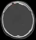 Non-contrast CT scan of the head showing an arachnoid granulation
