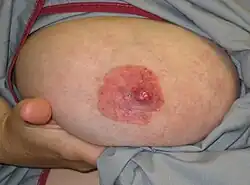 Paget's disease of the nipple[5]