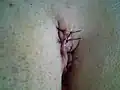 Pilonidal cyst two days after traditional closed surgery
