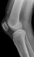 Quadriceps tendon rupture in plain X-ray