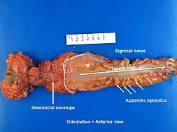 Abdominoperineal resection specimen. Gross pathology.