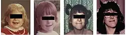Censor bars used to anonymise a woman with familial dysautonomia