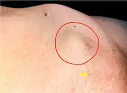 A small bump on the abdomen