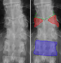 X-ray image of the lower spine with colored overlays highlighting anatomical features and malformations. The butterfly vertebra (red) in the middle is split vertically. Below that, you see the typical rectangular vertebra (blue). Above that, the neighbouring vertebra (green) shows signs of deformation caused by the presence of the butterfly vertebra.