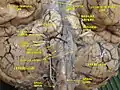 Cerebrum.Inferior view. Deep dissection.