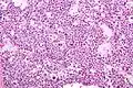 Micrograph of a spermatocytic tumor. H&E stain.