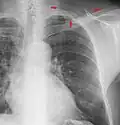 The inferior skin folds of the supraclavicular fossa may give the impression of a periosteal reaction of the clavicle