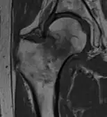 T1-weighted turbo spin echo MRI confirms a fracture, as the surrounding bone marrow has low signal from edema.