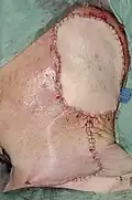 A free ALT flap for coverage; a selective neck dissection was also performed