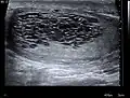 Tubular ectasia of the rete testis
