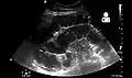 Small bowel obstruction on ultrasound[22]