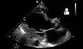 Ultrasound showing severe systolic heart failure[74]