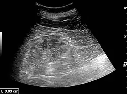 Chronic renal disease caused by glomerulonephritis with increased echogenicity and reduced cortical thickness. Measurement of kidney length on the US image is illustrated by '+' and a dashed line.[72]
