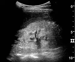 Nephrotic syndrome. Hyperechoic kidney without demarcation of cortex and medulla.[72]