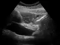 Dilatation of CBD due to an ampullary tumor.