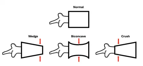 Demonstrates the different patterns seen with vertebral compression fractures: Wedge (left), Biconcave (center), Crush (right).