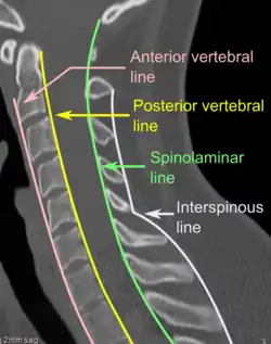CT scan of normal congruous vertebral lines[11]