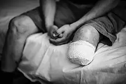 Man with an amputated leg in Kyiv Hospital. Photo displayed at an exhibition by Still Miracle Photography in London