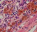 Micrograph showing melanosis coli, which appears as brown pigmentation in the macrophages in the lamina propria