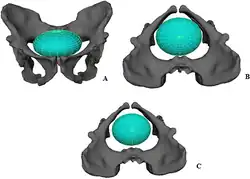 Reconstitution de la naissance d'un nouveau-né (en bleu) dans le bassin d'un Australopithecus sediba, vue sous plusieurs angles.