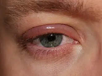 Description de l'image Blepharitis.JPG.