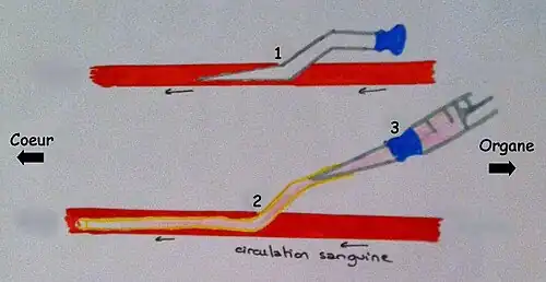 Schéma d'une canulation veineuse