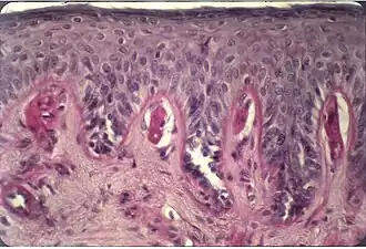 Description de l'image Cutaneous histological features of EPP.jpg.
