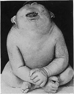 Enfant atteint de cyclopie, 1920.